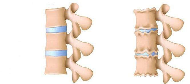 Mis on osteokondroos