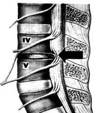 X -Ray pilt osteokondroosi nimmeosakonnast