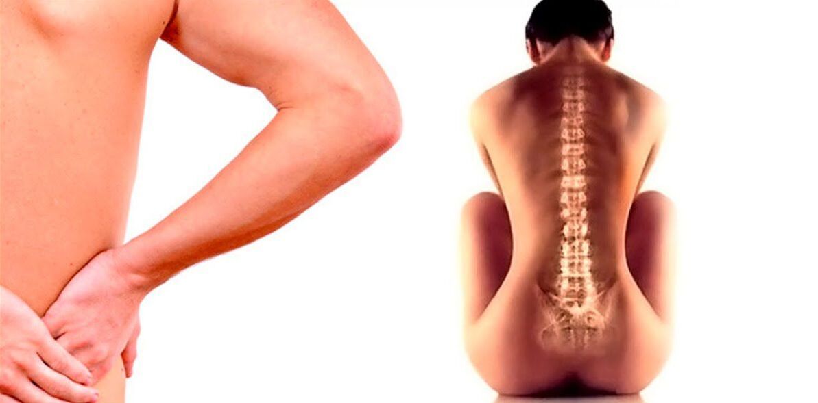 osteokondroosist tingitud alaseljavalu
