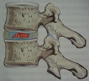 Osteokondroosi esimene etapp